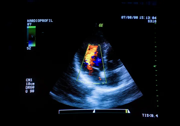 Ultrasound