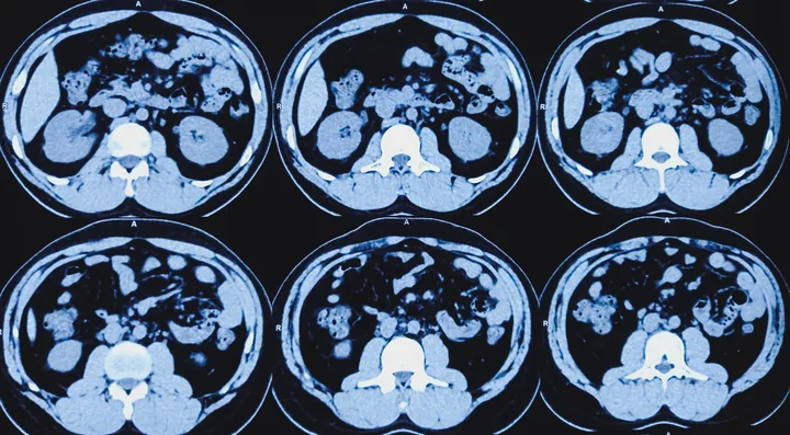 CT — Abdomen