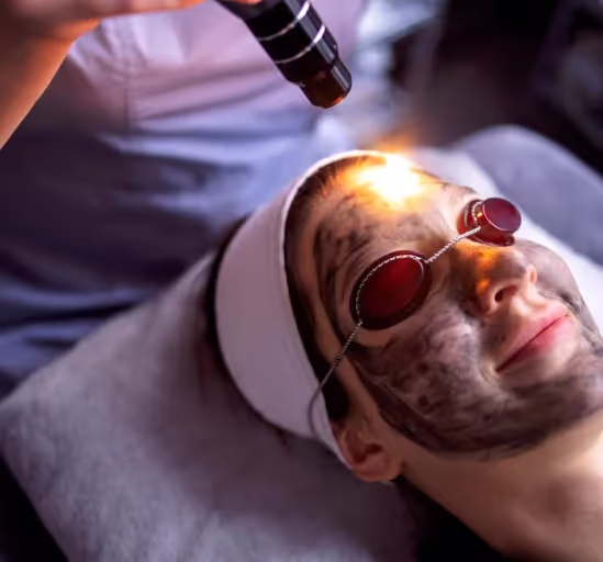 Laser Carbon Facial Done by an expert dermatologist