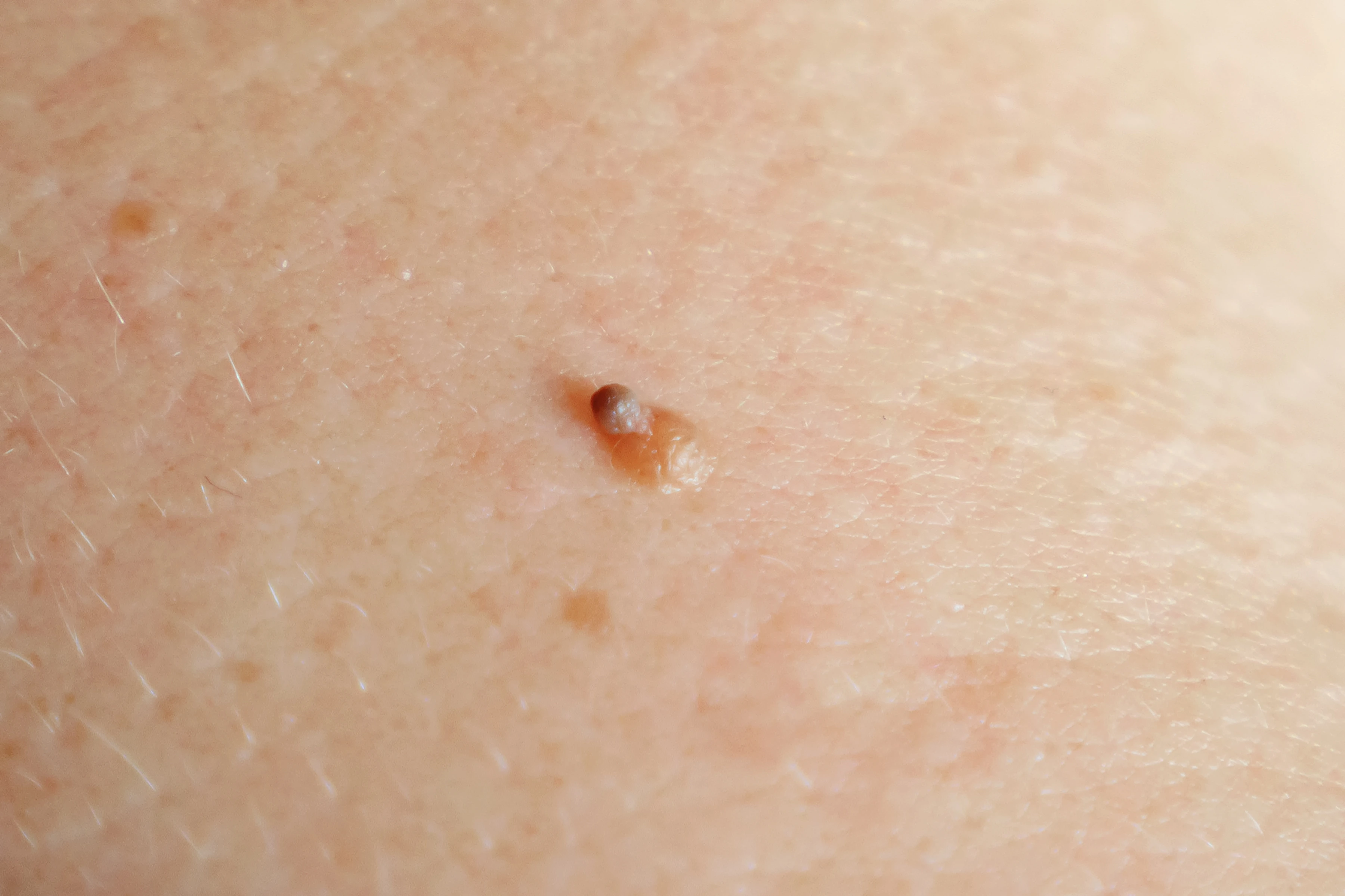 Skin Tags 