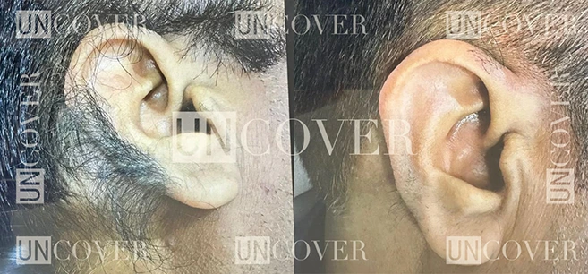 How to remove ear hair permanently - Easy and Safe methods 