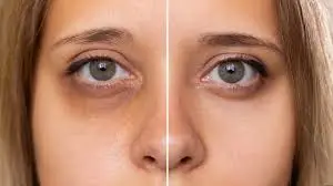 How to remove dark circles? Natural home remedies you must know.