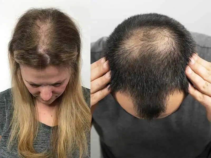 बालों का झड़ना कैसे रोकें? (Balon Ka Jhadna Kaise Roke) | कारण, इलाज और असरदार उपाय