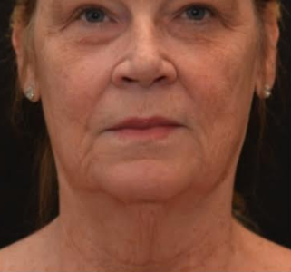Patient getting cosmetic dermatology treatment