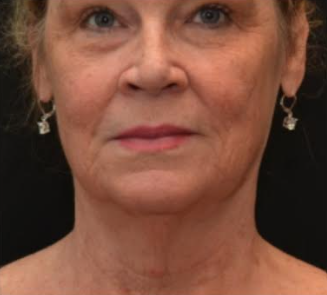 Patient getting cosmetic dermatology treatment