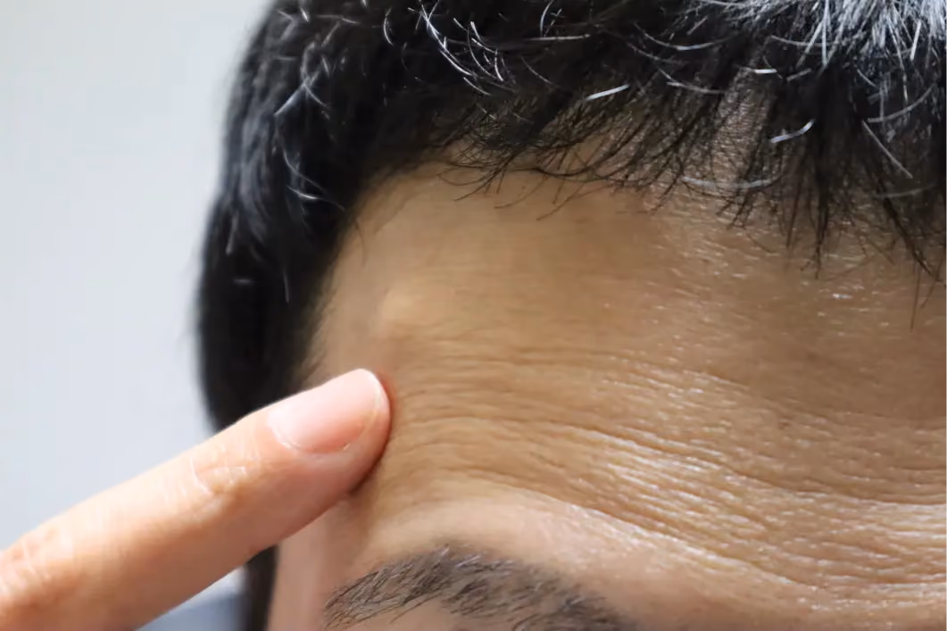 Cysts and Lipomas Removal