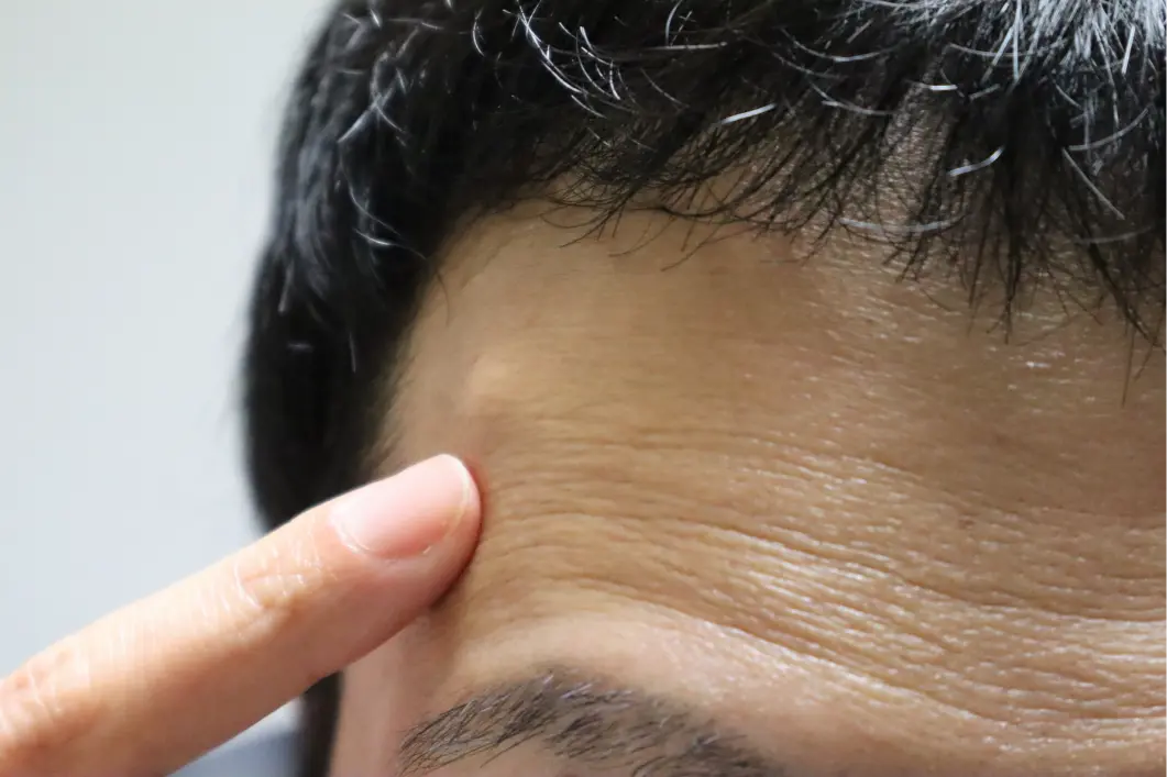 Cysts and lipomas