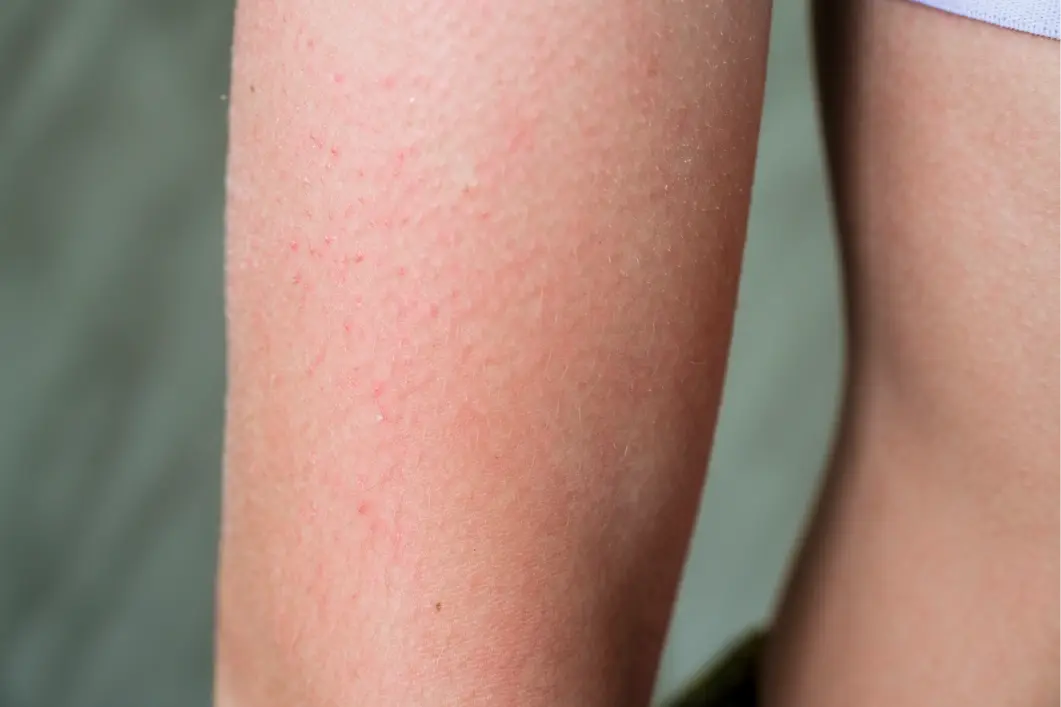 Actinic Keratosis