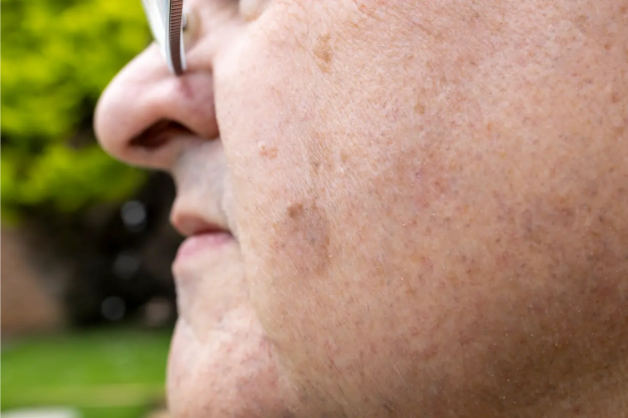 Seborrhoeic Keratosis