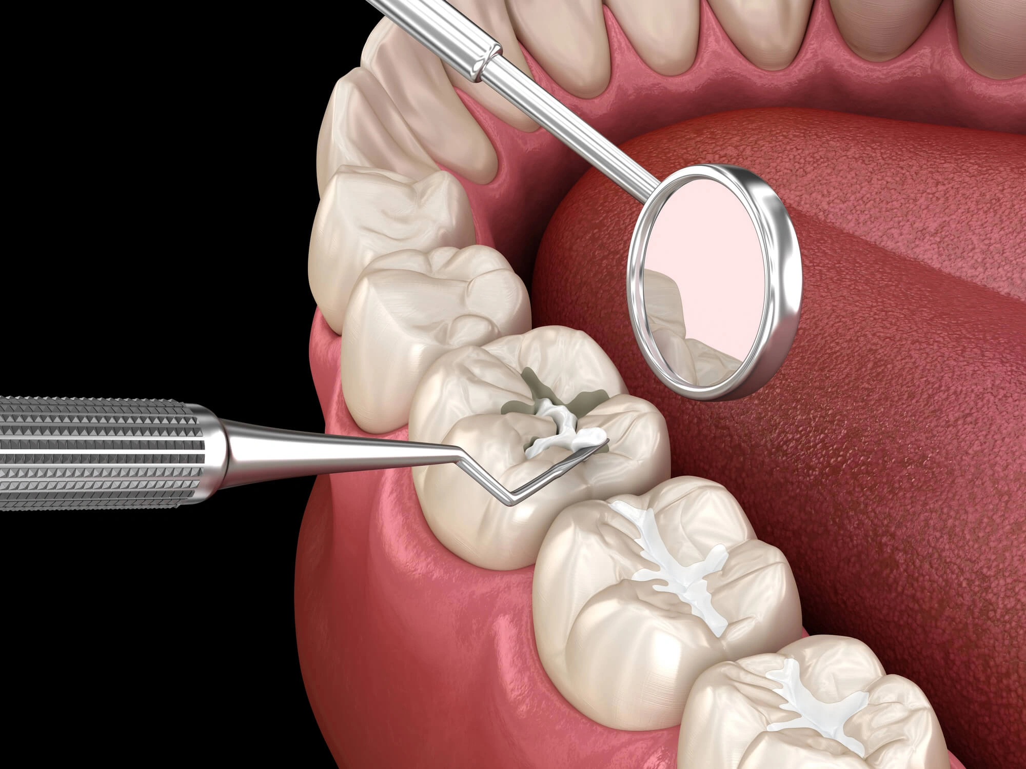 Dental sealants 3D illustration by steele creek modern dentistry