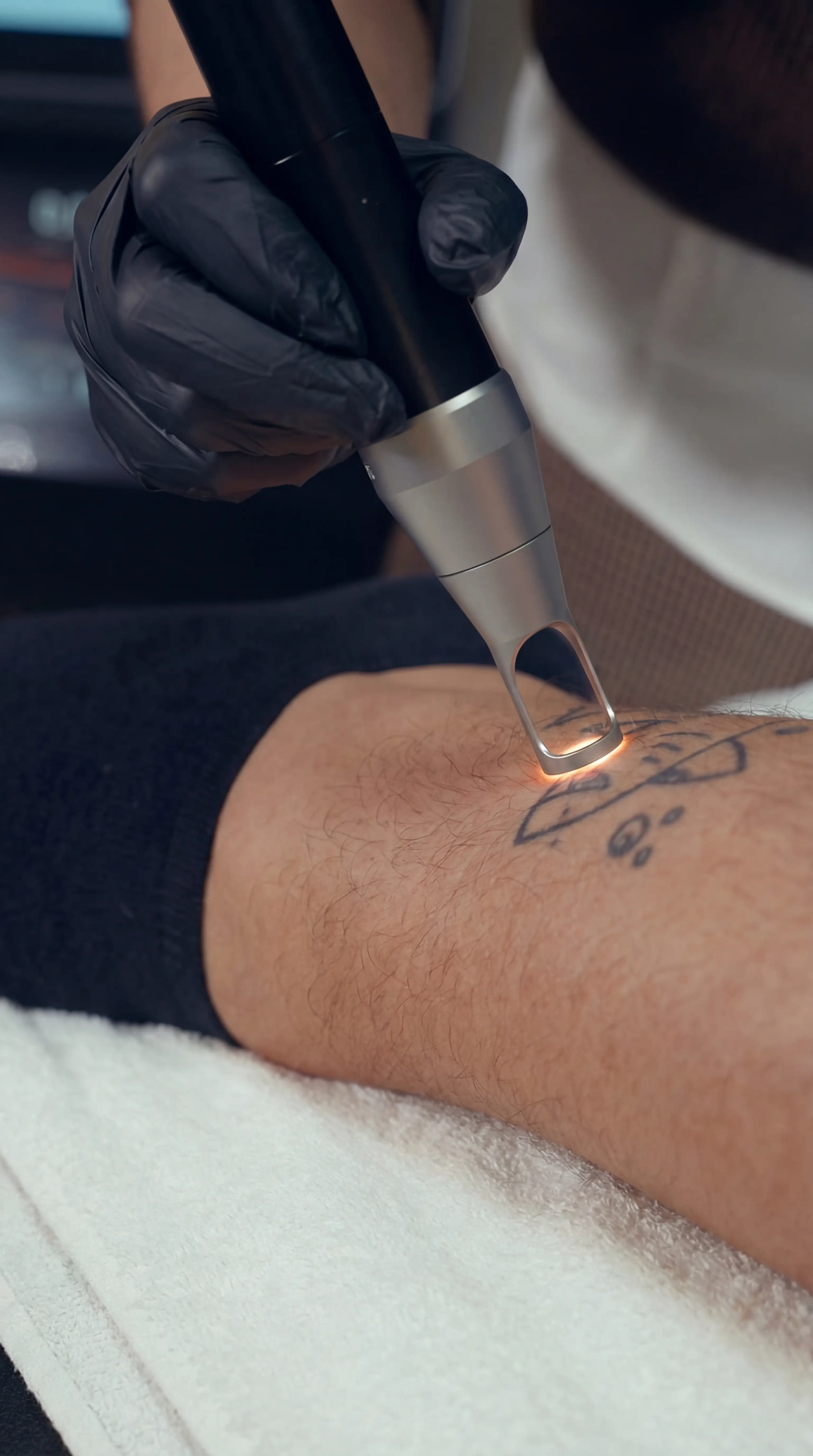 Person mit schwarzem Handschuh, der ein Lasergerät zur Tattooentfernung auf einem tätowierten Unterarm hält.