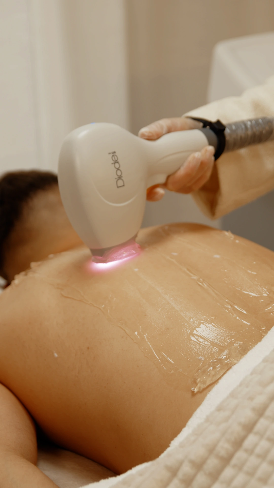 Person receiving Diode laser treatment on their back with gel applied on the skin.