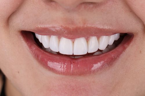 Photo of a smiling person with porcelan veneers made in Colombia by GR Dents. Porcelain veneers before and after photo.