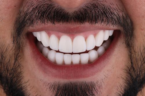 Photo of a smiling person with porcelan veneers made in Colombia by GR Dents. Porcelain veneers before and after photo.
