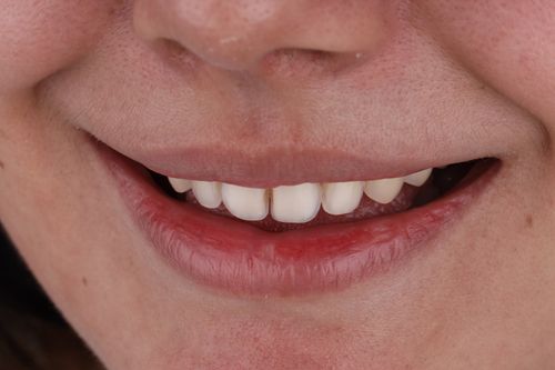 porcelain veneers photo. GR Dents Patient. Porcelain Veneers in Colombia