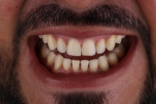 porcelain veneers photo. GR Dents Patient. Porcelain Veneers in Colombia