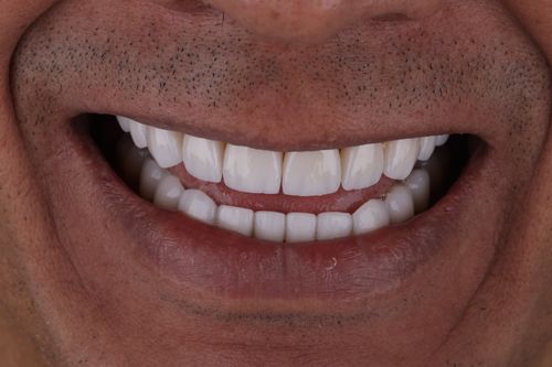Photo of a smiling person with porcelan veneers made in Colombia by GR Dents. Porcelain veneers before and after photo.