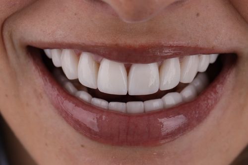 Photo of a smiling person with porcelan veneers made in Colombia by GR Dents. Porcelain veneers before and after photo.