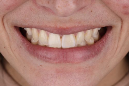 porcelain veneers photo. GR Dents Patient. Porcelain Veneers in Colombia