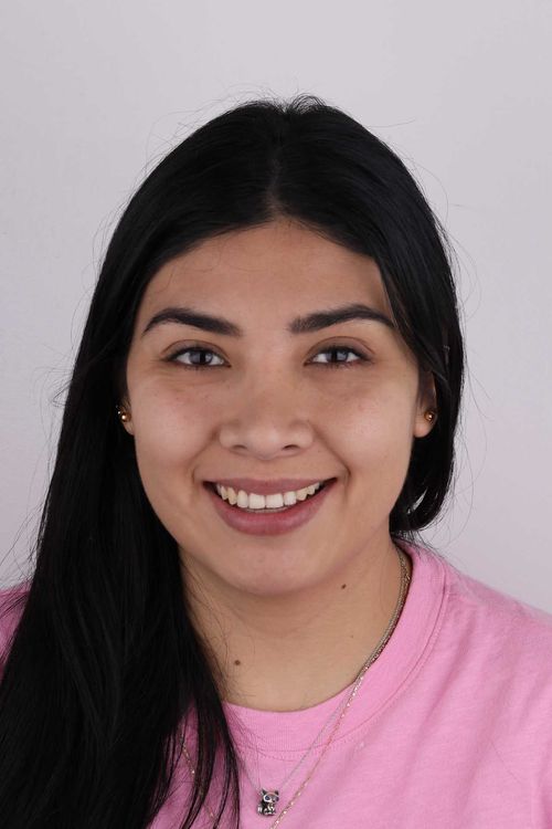 porcelain veneers photo. GR Dents Patient. Porcelain Veneers in Colombia