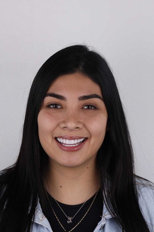 porcelain veneers photo. GR Dents Patient. Porcelain Veneers in Colombia