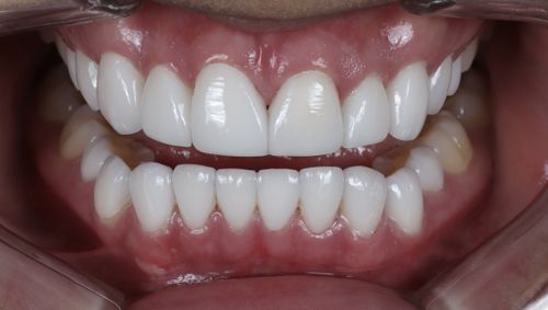 porcelain veneers photo. GR Dents Patient. Porcelain Veneers in Colombia