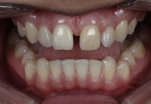 porcelain veneers photo. GR Dents Patient. Porcelain Veneers in Colombia