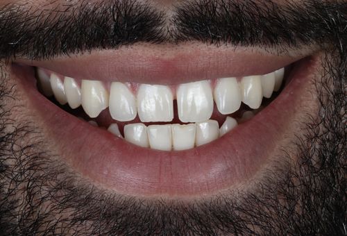 porcelain veneers photo. GR Dents Patient. Porcelain Veneers in Colombia