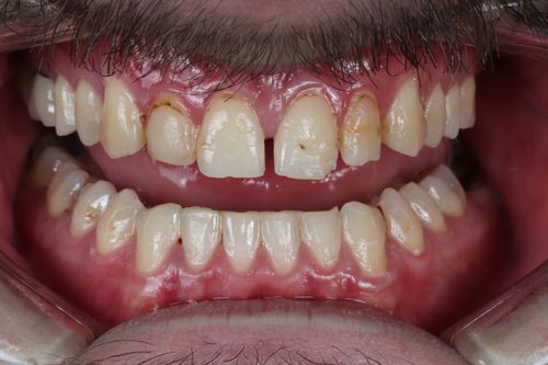 porcelain veneers photo. GR Dents Patient. Porcelain Veneers in Colombia