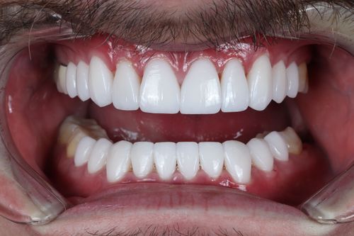 porcelain veneers photo. GR Dents Patient. Porcelain Veneers in Colombia