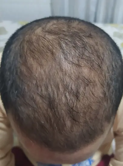 Resultado do Maureci depois de 12 meses de tratamento