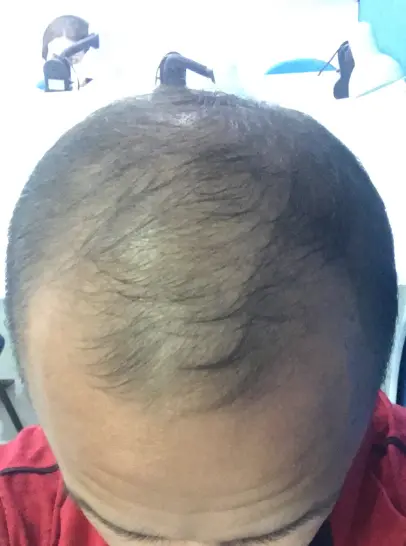 Foto do cabelo do Paulo antes de iniciar o tratamento