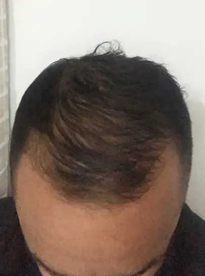 Resultado do Paulo depois de 5 meses de tratamento