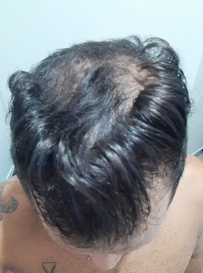 Foto do cabelo do Raul antes de iniciar o tratamento