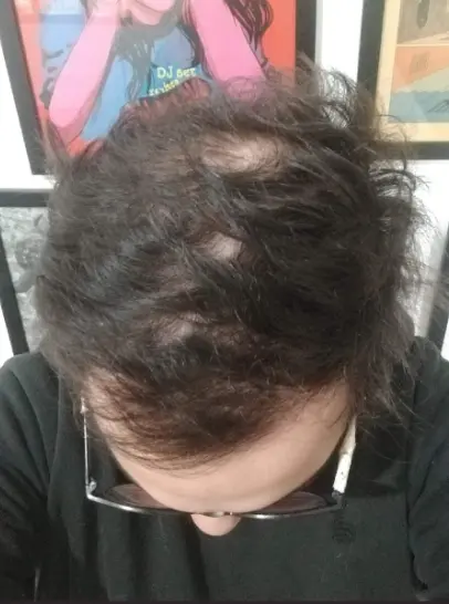 Foto do cabelo do Ricardo antes de iniciar o tratamento