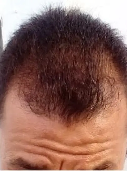 Foto do cabelo do Samuel antes de iniciar o tratamento