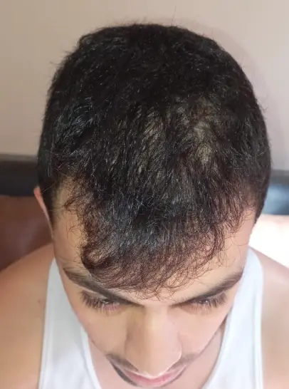 Foto do cabelo do Victor antes de iniciar o tratamento