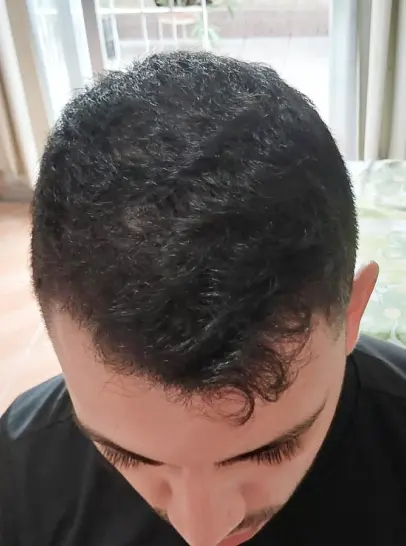 Resultado do Victor depois de 3 meses de tratamento
