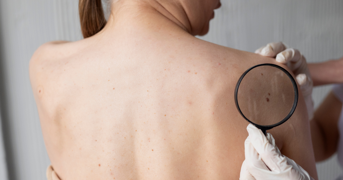 O que é câncer de pele?