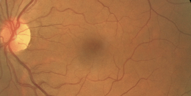 Retinacheck