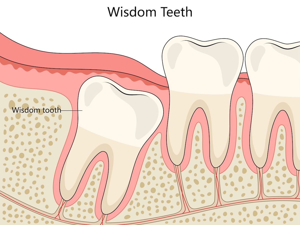 Wisdom Teeth: What You Need to Know