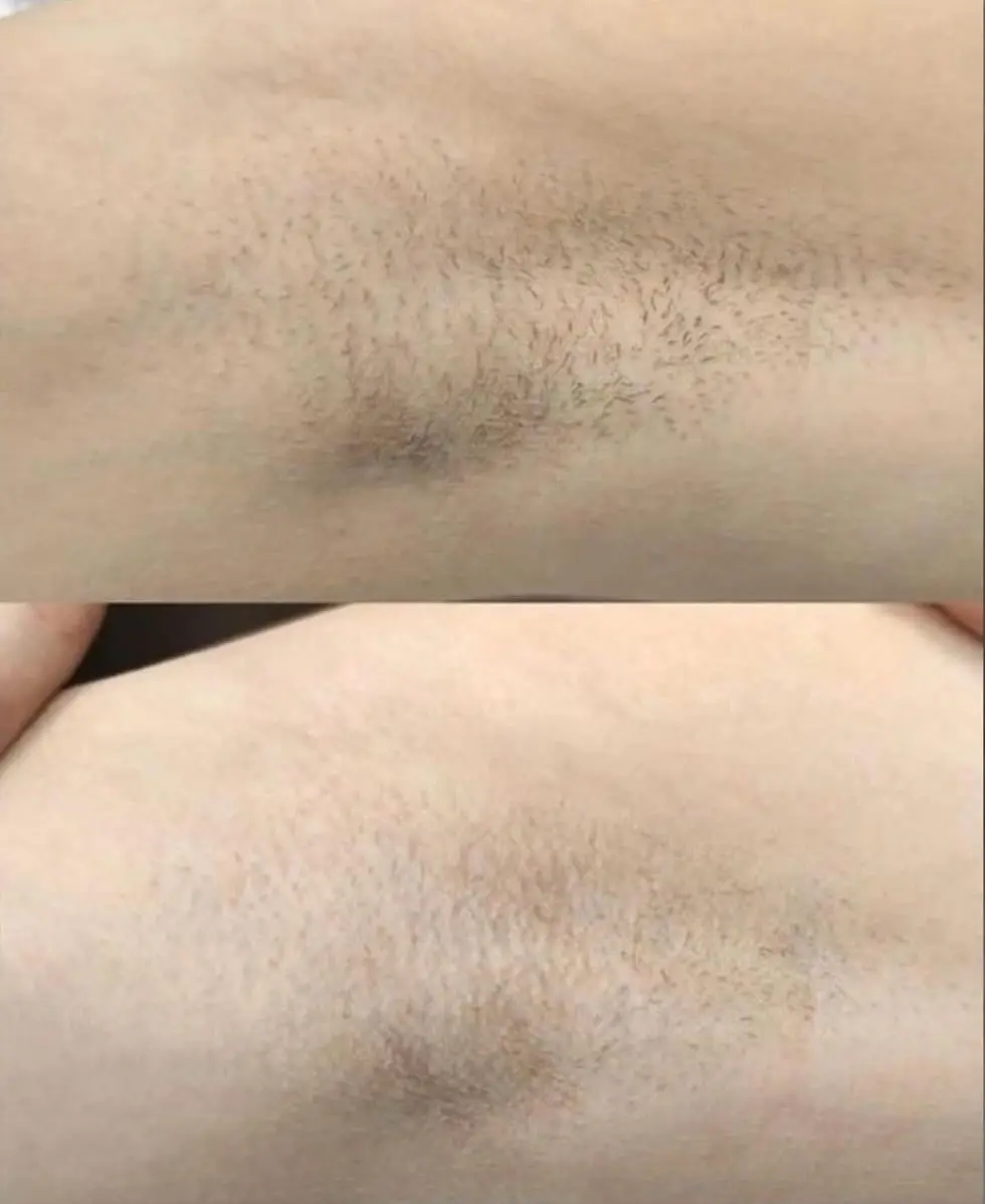 Underarm laser hair removal before and after