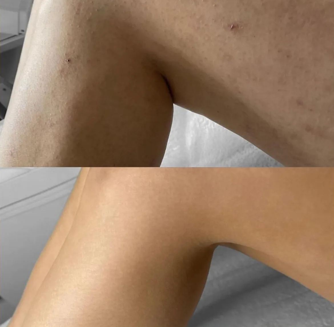 Leg laser hair removal before and after