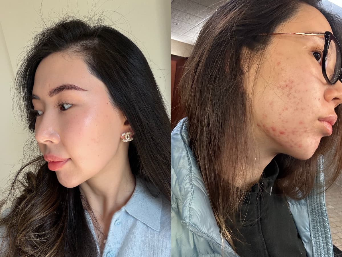 Morpheus8 full face transformation before and after