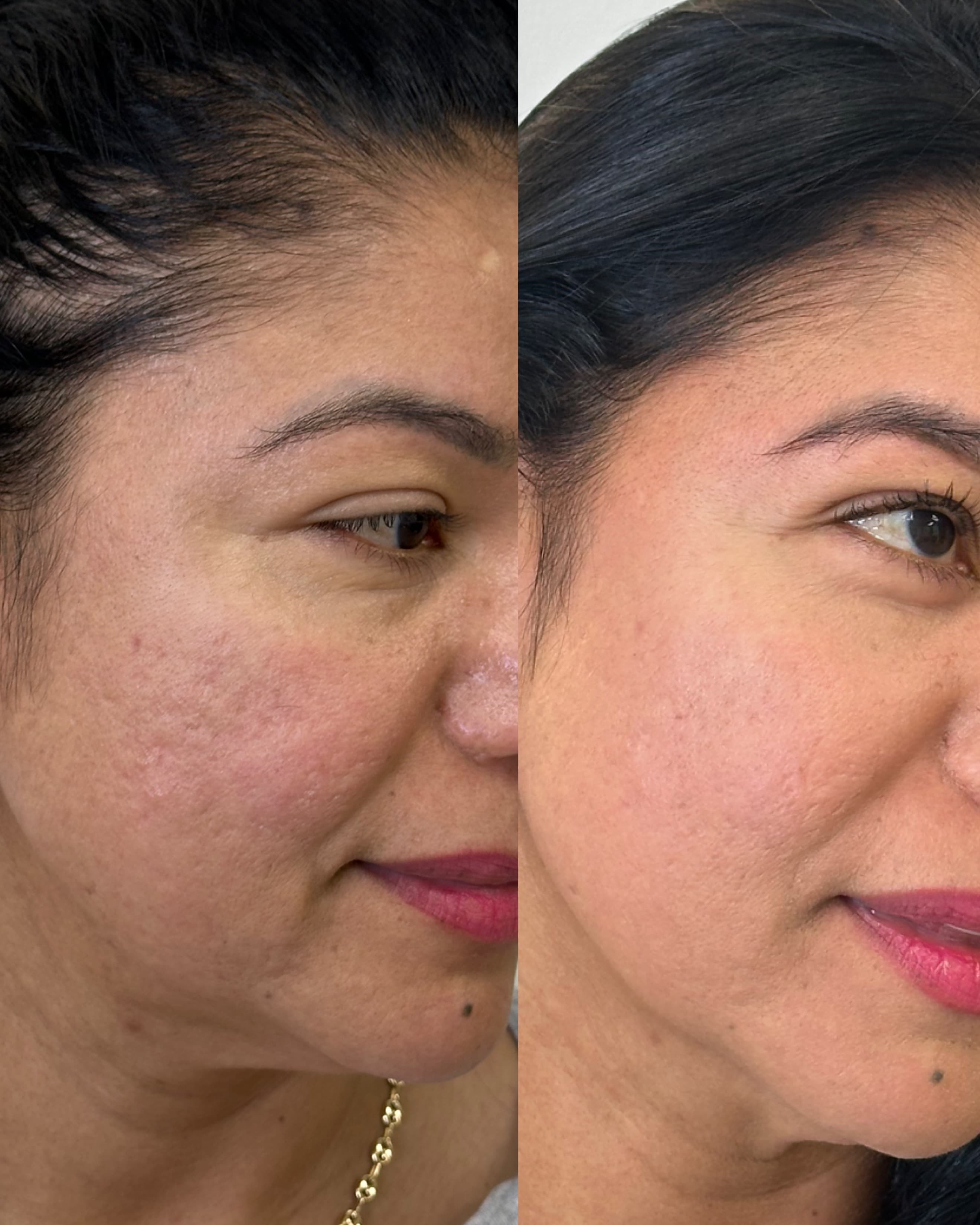 Morpheus8 face rejuvenation before and after