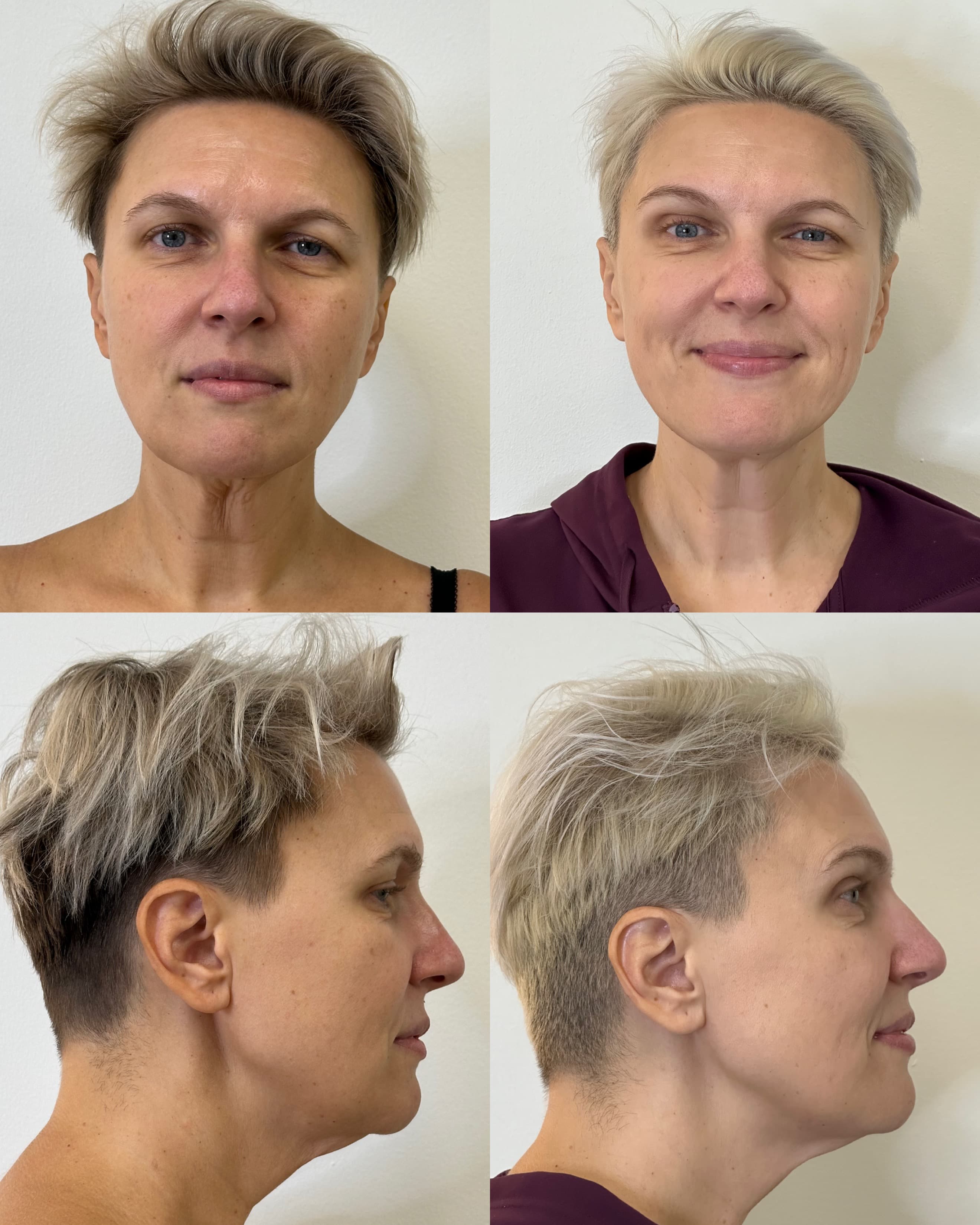 Morpheus8 face skin tightening before and after