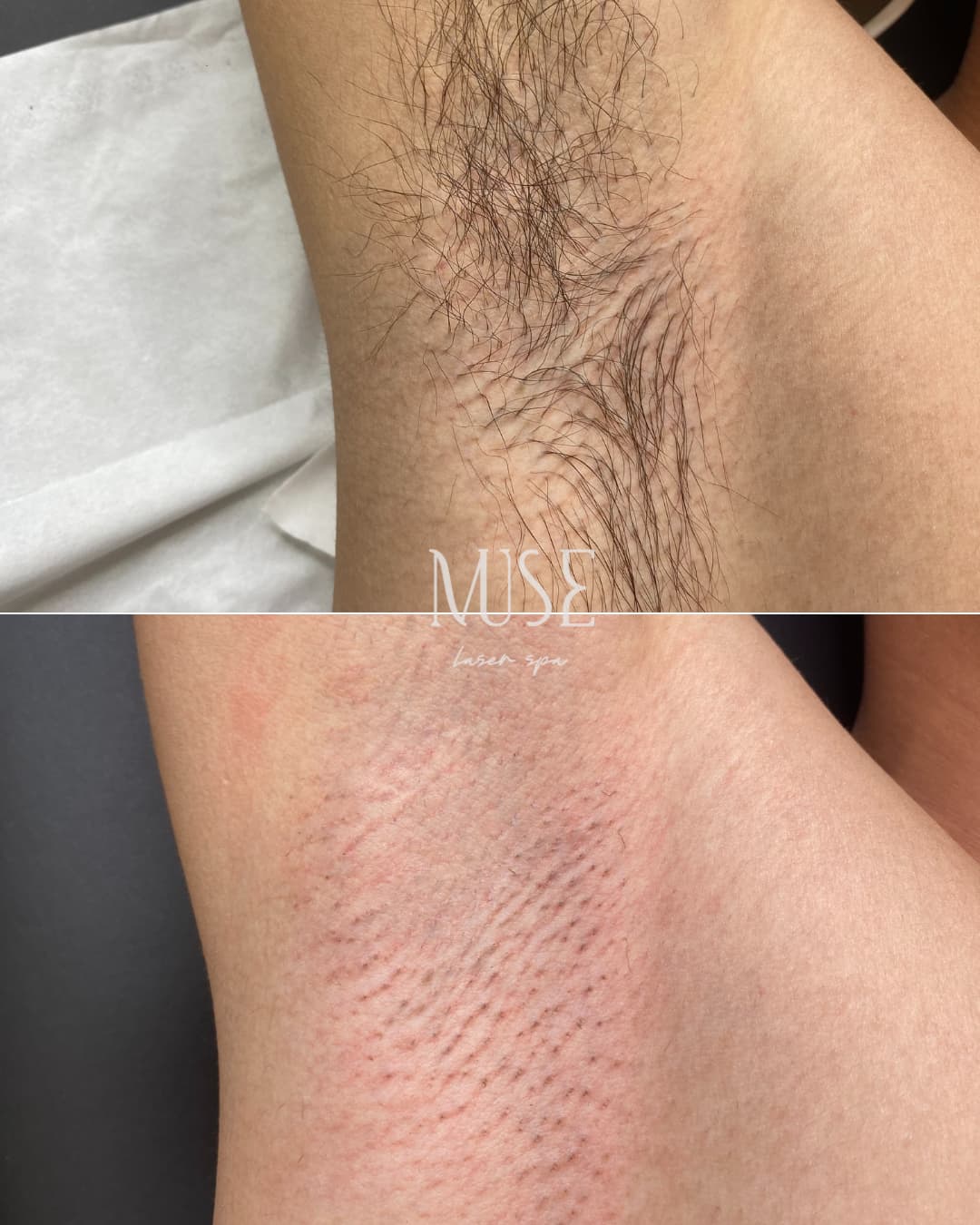 Laser hair removal underarms before and after