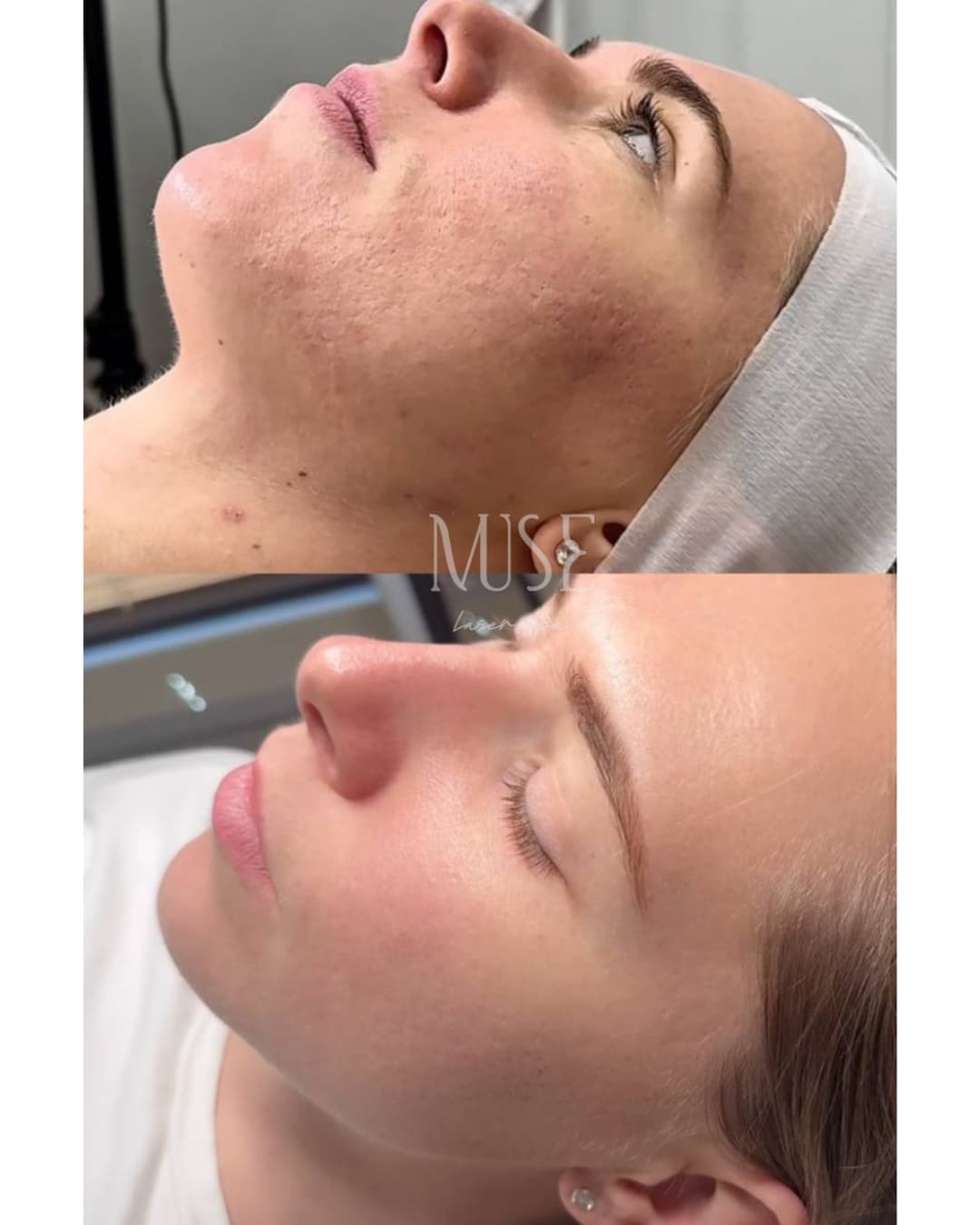 SkinPen microneedling before and after — glow