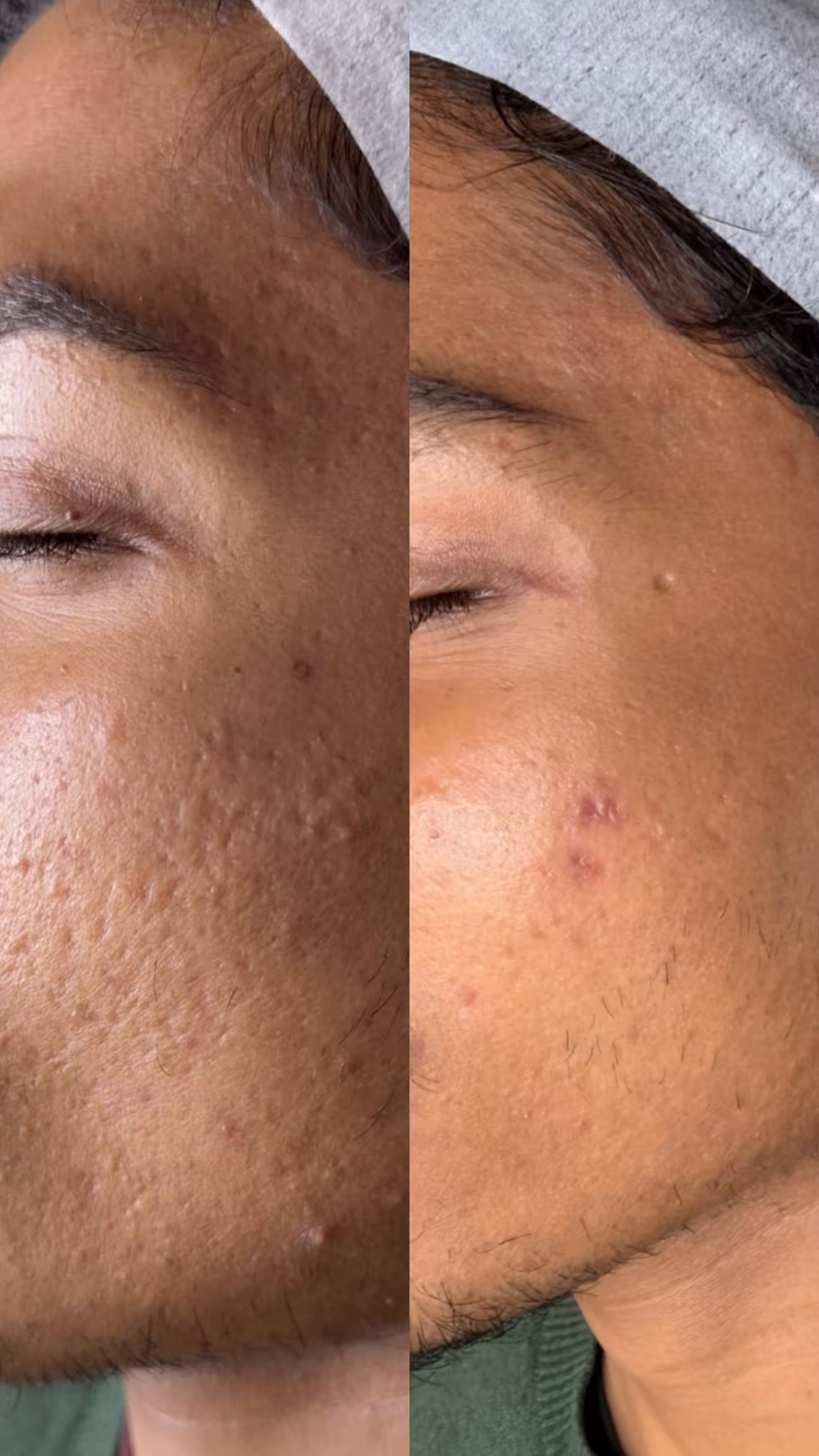 SkinPen microneedling before and after — texture