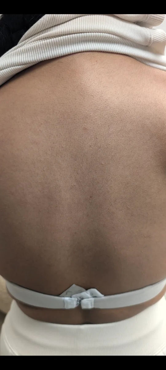 Back after laser hair removal